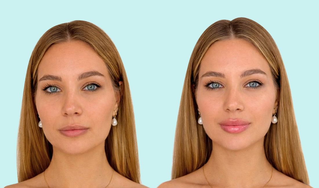 Mujer antes y después de tratamiento de armonización facial