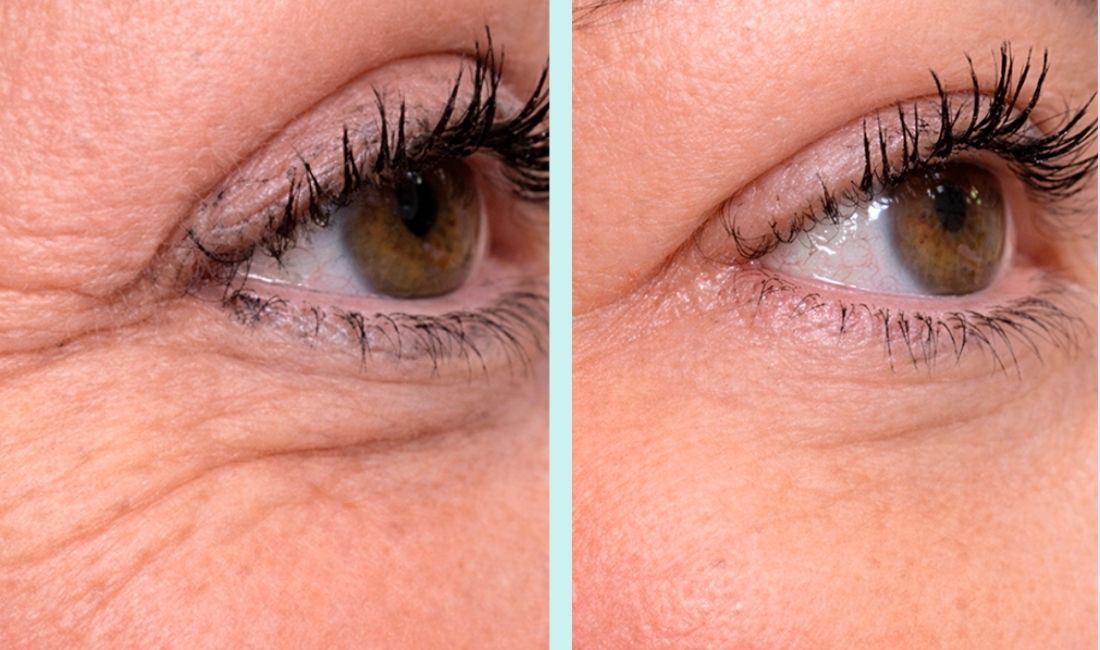 Mujer antes y después del tratamiento anti-arrugas