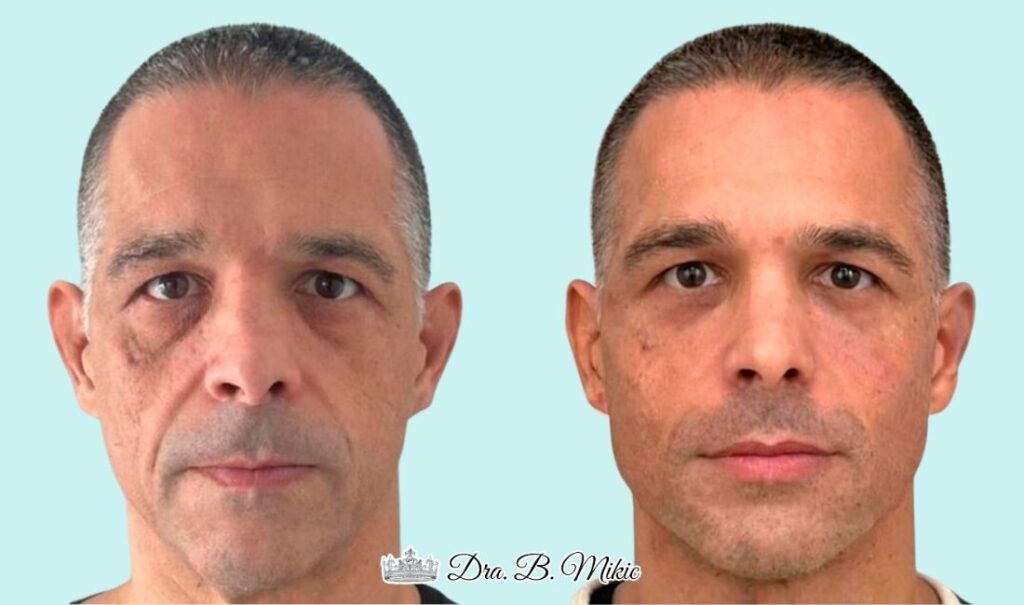 Hombre antes y después de tratamiento de armonización