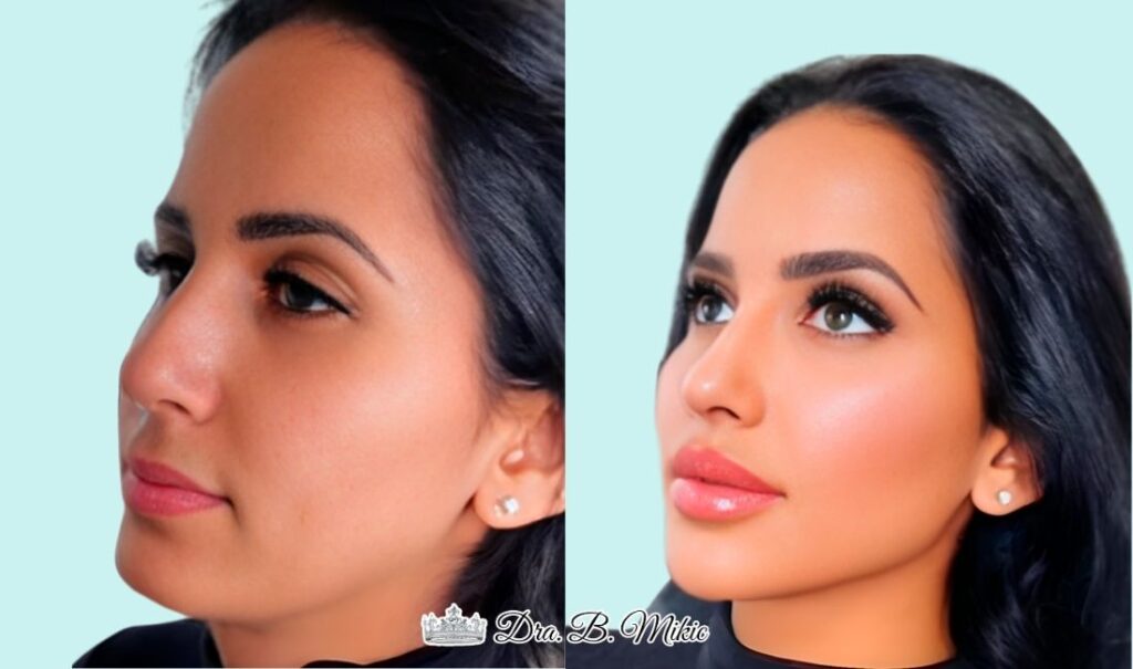 Mujer antes y después de tratamiento de armonización