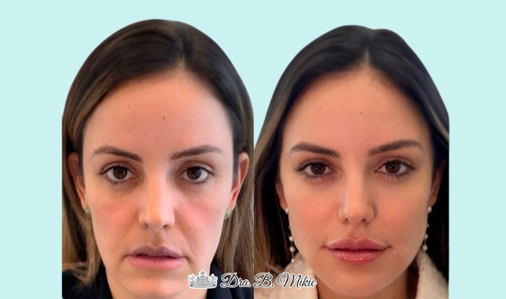 Mujer antes y después de tratamiento de armonización