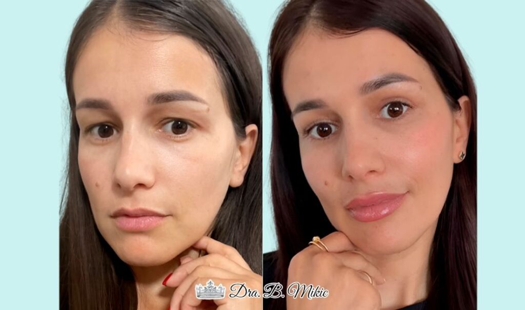 Mujer antes y después de tratamiento de armonización