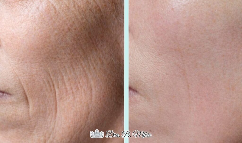 Mujer antes y después de tratamiento de bioestimuladores de colágeno