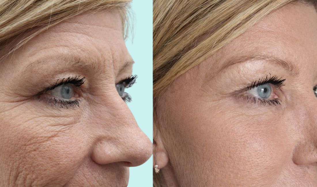 Mujer antes y después de tratamiento de bioestimuladores de colágeno