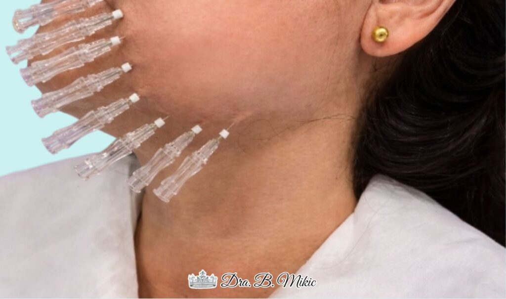 Mujer realizando el tratamiento de hilos tensores