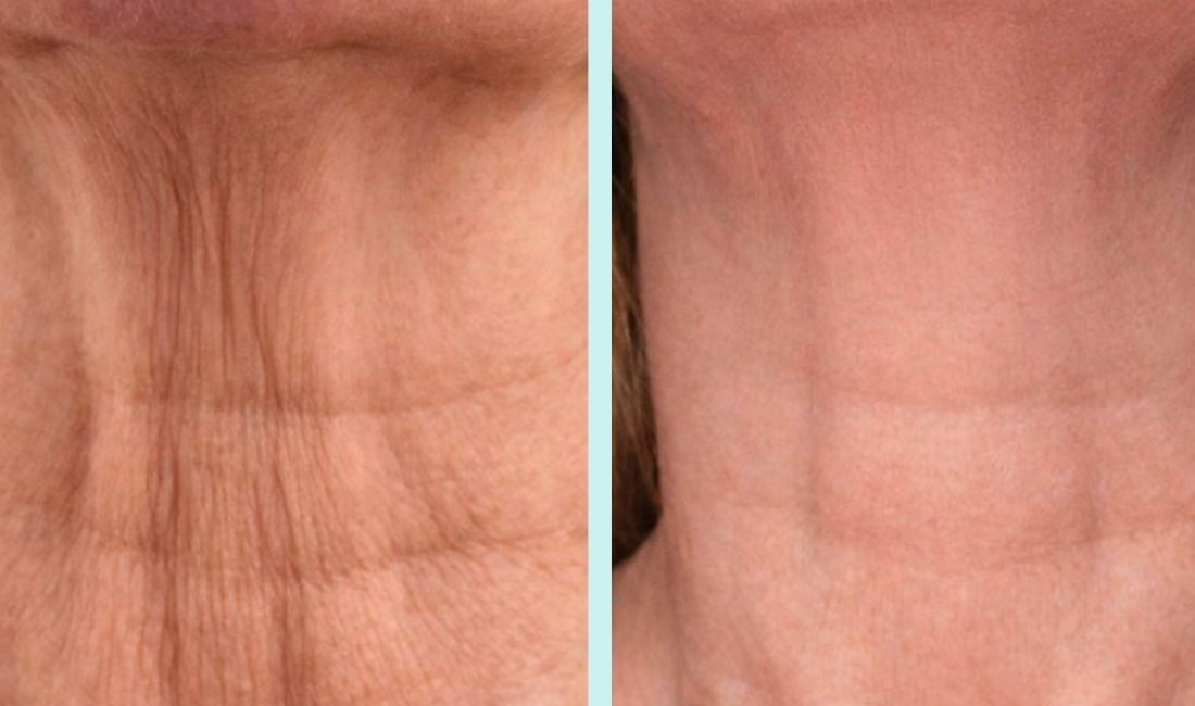 Mujer antes y después de lifting de cuello sin cirugía