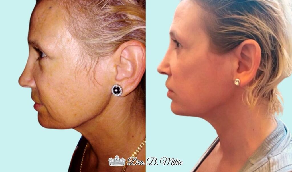 Mujer antes y después del lifting facial sin cirugía