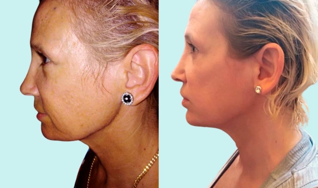Mujer antes y después de lifting facial