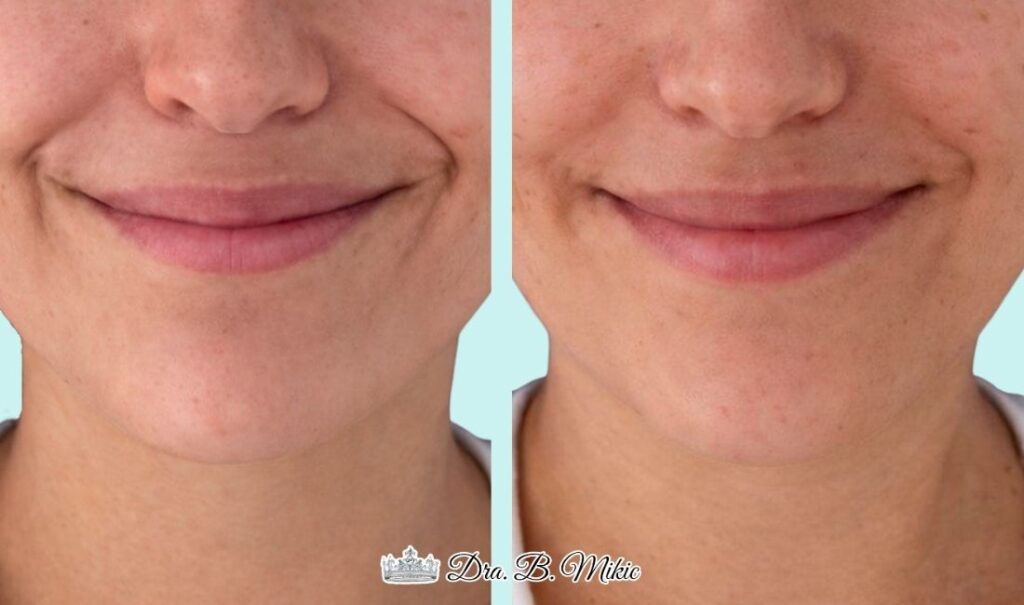 Mujer antes y después de tratamiento reductor de lineas de marioneta