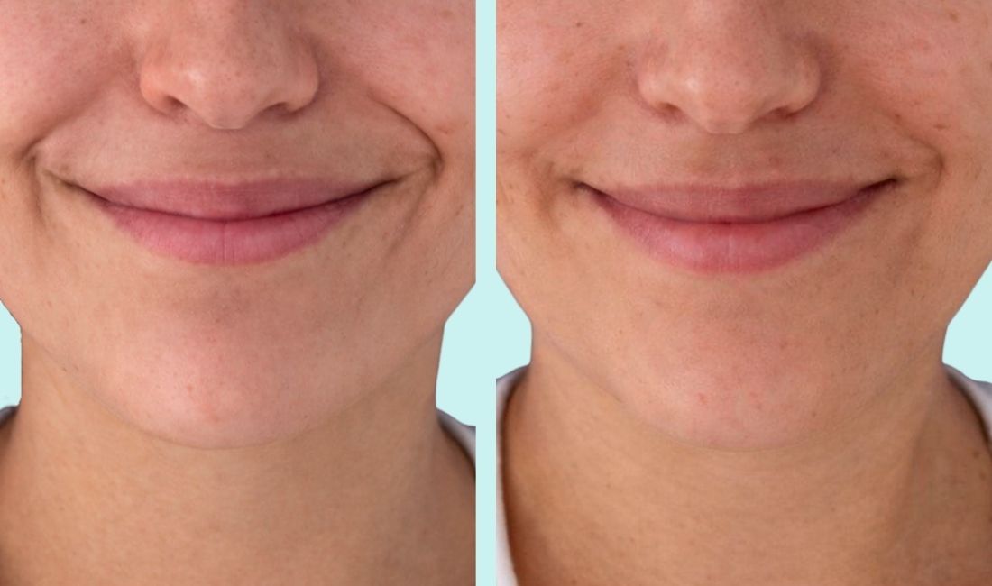 Mujer antes y después de tratamiento reductor de lineas de marioneta