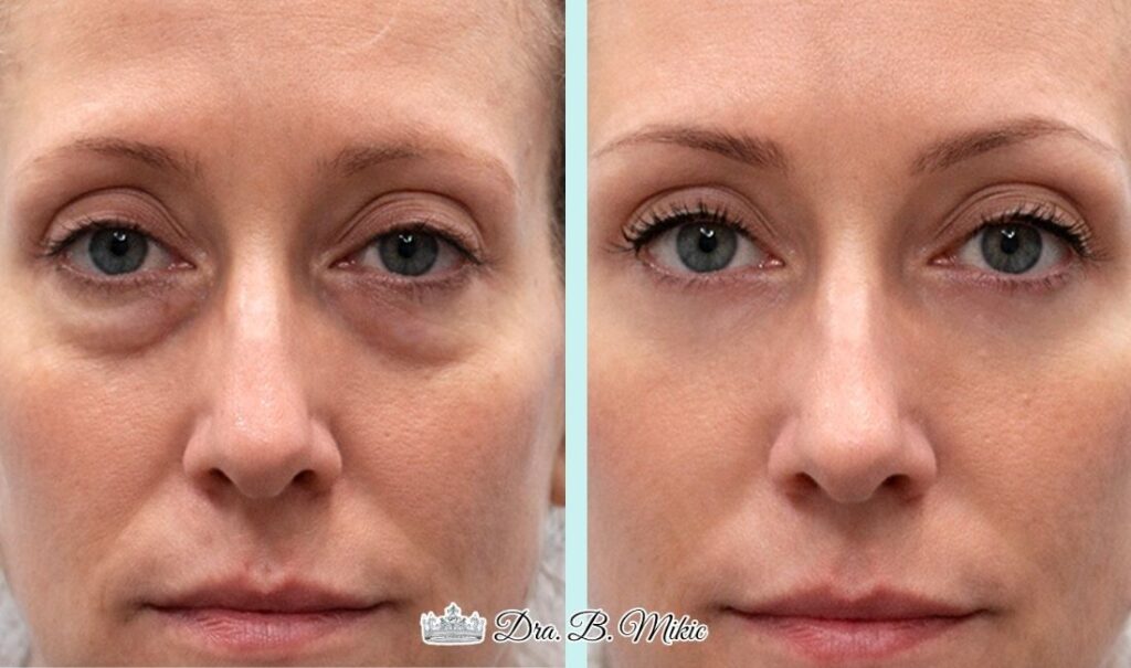 Mujer antes y después de tratamiento reductor de ojeras