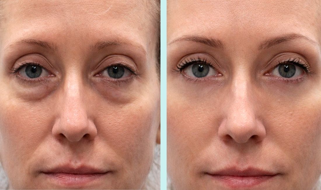 Mujer antes y después de tratamiento reductor de ojeras